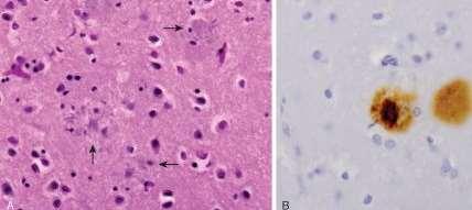Amyloid angiopathy: (1) Aβ is present in cerebral vessels.