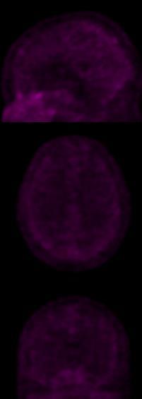 Imaging Tau (with 18 F-MK6240) Excellent