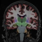 Imaging Neurodegeneration with