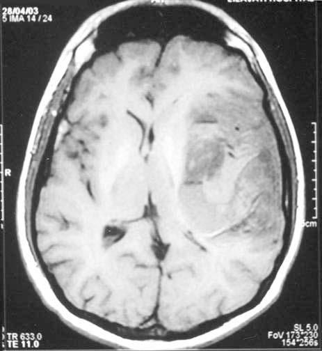 within it, suggestive of a hemorrhagic venous infarct with areas of recurring bleed. There was significant adjacent mass effect with perilesional edema causing a subfalcine herniation.