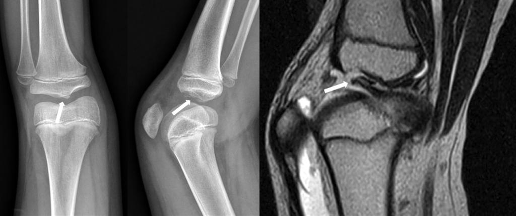 Fig. 1. () preoperative plain radiograph of an eight-year-old girl with type III avulsion fracture of the tibial spine (arrows).