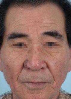 979 The symmetry of the eyebrows did not change after the procedure.