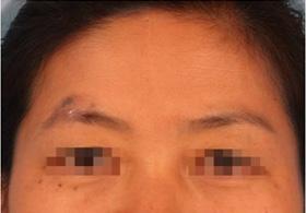 No severe complications, such as flap necrosis, occurred after median forehead flap procedures.