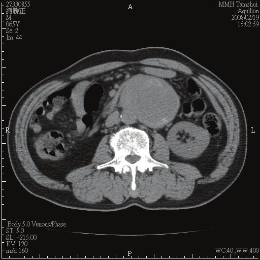 258 C. C. Tsai et al./jcos 24(2008) 256-261 (a) (b) Figure 1. (a) Unenhanced abdominal CT scan demonstrates an 8x7-cm soft-tissue mass adjacent to the aorta.
