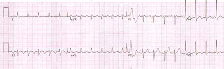 Note the Extra Atrial Waves (down arrows) Exactly