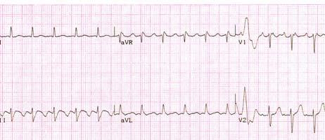 Note the PR Interval of the Discernible Atrial Wave in