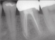 Endodontic treatment requires