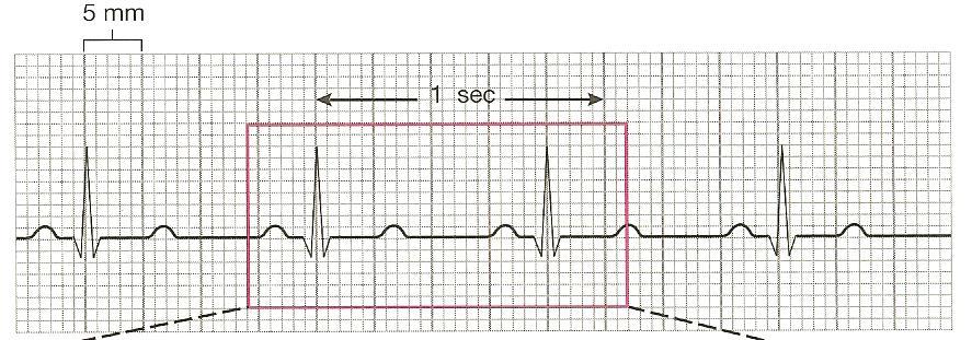 - Heart rate is normally timed from the beginning of one P wave to the beginning of the next P wave or from peak of one R wave to peak of next R wave Waves: Deflections above or below the baseline