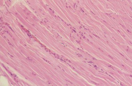 Neovascularization Fibrosis and calcifications LACK
