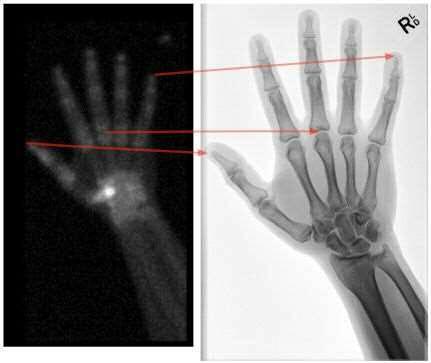 Patient with infection: Patient with joint disease: Nuclear medicine scans