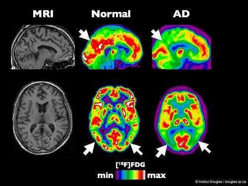 MRI and PET scans of brain,