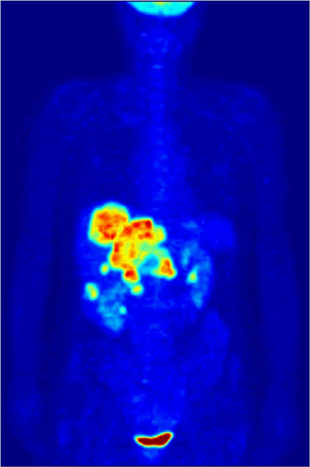 (animation) Maximum Intensity Projection (MIP) of a wholebody positron emission tomography (PET) acquisition of a 79 kg (174 lb) weighting female after intravenous injection of 371 MBq of 18 F-FDG