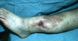 Squamous cell carcinoma and amyloidosis are rare complications Chronic Chronic Bone loss and drainage through sinus