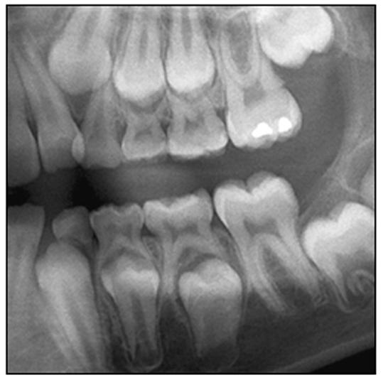Incorrect mounting and labeling of the reverse radiograph can result in misdiagnosis and treatment of the wrong tooth. Figure 26.