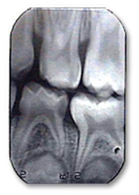Positioning the Radiograph Positioning the radiograph vertically in the