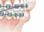 To maintain this pressure, your braces need to be adjusted about every 4 to 8 weeks.