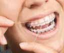 Brush Often Brush your teeth and braces as often as you re told to by your orthodontist.