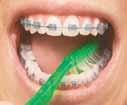 Below are tips on how to brush properly: Be sure to brush between the wires and brackets of your braces. Gently brush the gums as well.