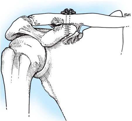 and repair ligament - Phemister, modified