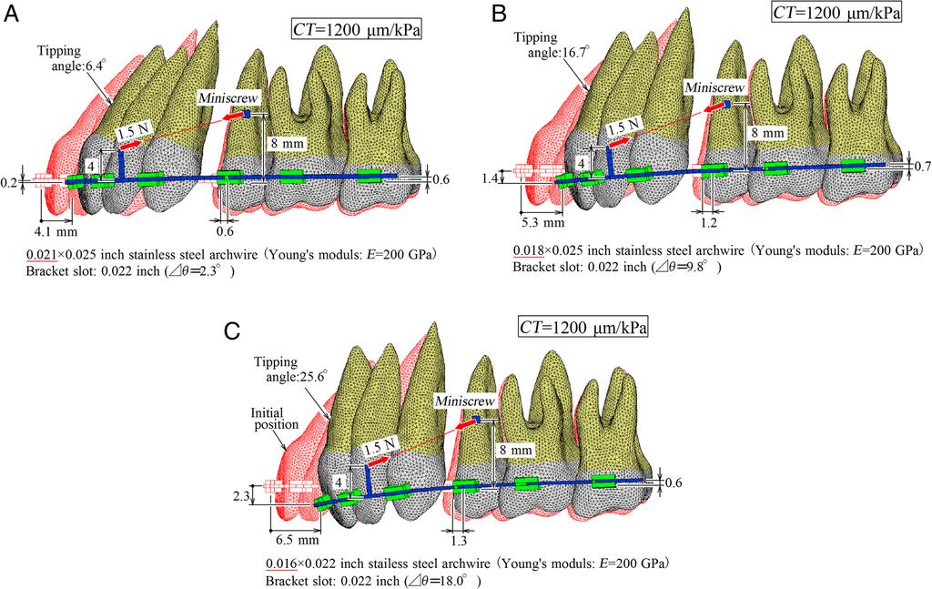 Kawamura and Tamaya Progress in Orthodontics (2019) 20:3 Under the above assumptions, the finite element model for simulating the long-term orthodontic movement was constructed of the archwire, the