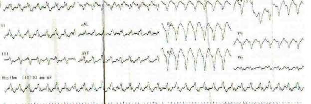 ARVD Co-existing with Non-compaction But right ventricular volumes and wall motion was normal. To investigate concealed brugada an ajmalin test was ordered.