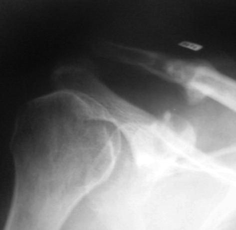 310 Y. BASYONI, A.-E.-R. A. EL-GANAINY, M. ABOUL-SAAD Fig. 2. Postoperative radiograph demonstrating fracture of the coracoid process and dislocation of the acromioclavicular joint.