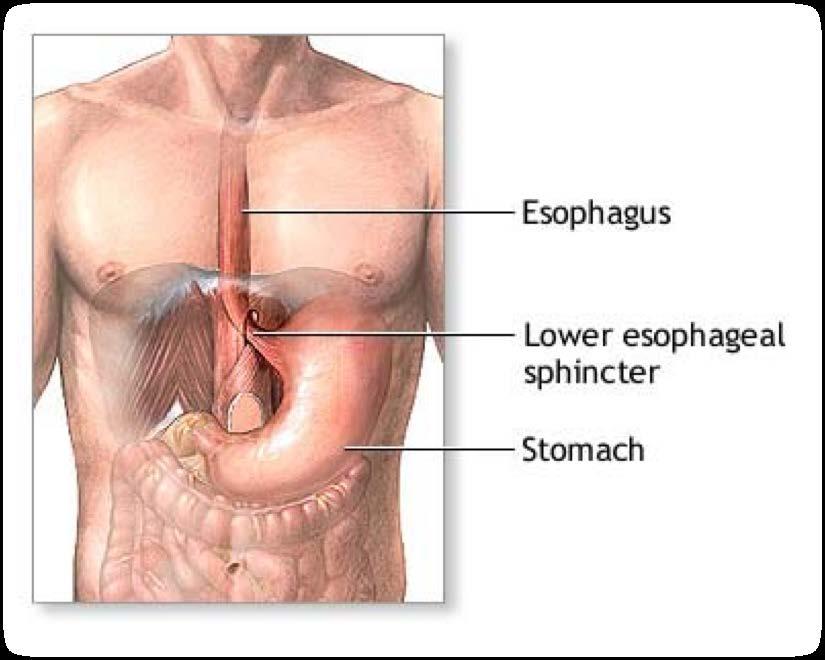 SCREENING FOR ESOPHAGEAL CANCER Barrett s Esophagus is a condition for which screening has shown benefit 2% of patients diagnosed with Barrett s will develop cancer annually Risk of developing