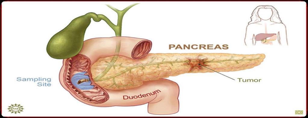 PANCREATIC CANCER SCREENING Routine screening is of limited value in average-risked individuals. Low incidence 8.