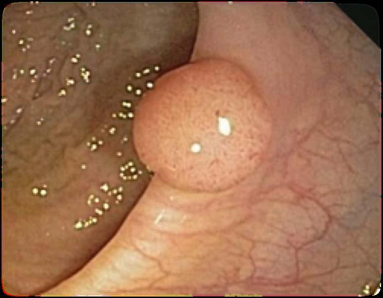 work groups followed 1,416 patients who had polyps removed incidence of