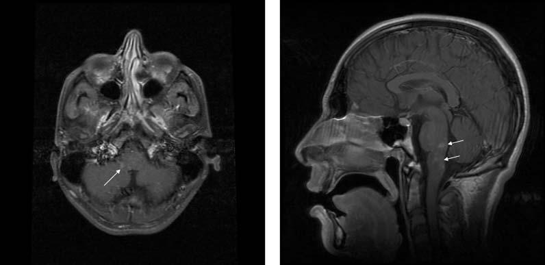 466 H. G. Hatipoglu et al. Fig. 3. Note the patchy contrast enhancement in the brainstem on the axial () and sagittal () post-contrast T1-weighted images (arrows).