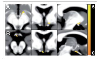 Increased Hypothalamic Volume in Chronic Cluster Neuroendocrine Alterations Reported in Migraine