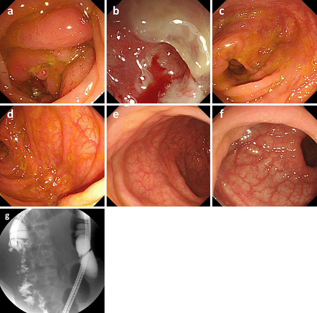 Figure 1. Colonoscopic findings on admission. a, b: Longitudinal ulcers and circumferential strictures blocking the advance of the scope were observed in the ascending colon.