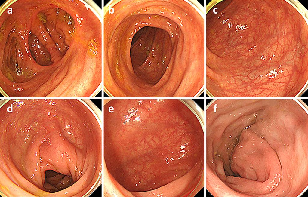 Figure 6. Colonoscopic findings at one month after the discontinuation of mesalazine. Improvement was observed in the findings of the large bowel (a: Postoperative bowel anastomotic site.