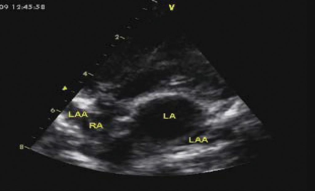 Fig. 6: 2D echocardiogram 4 chamber view demonstrating pyramidal shaped bilateral right atrial appendages.