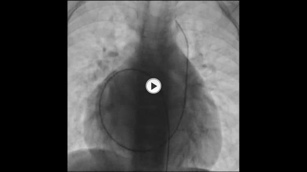 Fig. 13: Cardiac catheterization AP view demonstrating bilateral SVCs in right isomerism.