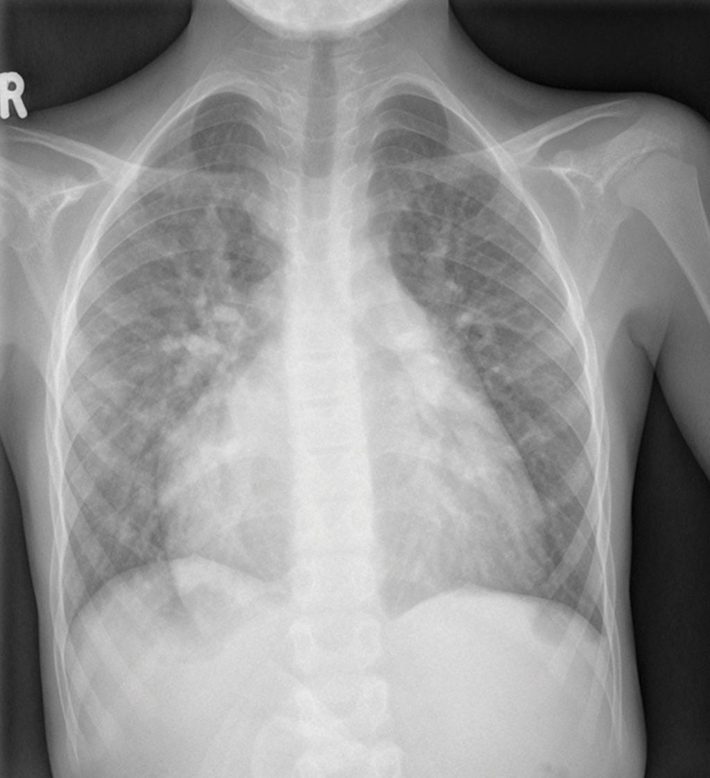 Fig. 2: Frontal chest radiograph demonstrating mesocardia with right-sided stomach bubble with prominent pulmonary