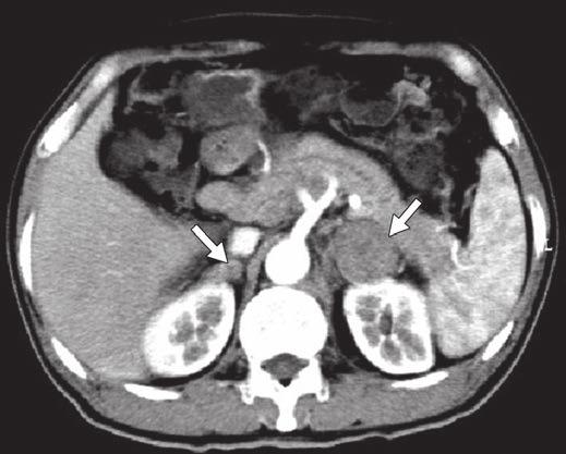 B, CT image reveals bilateral soft-tissue masses (arrows) in adrenals, which are showing heterogeneous enhancement.
