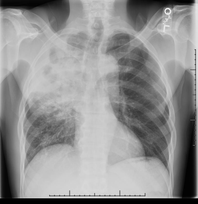 Reasons a Diagnosis of TB is Missed or Delayed Patient is diagnosed as a community acquired pneumonia and responds to a fluoroquinolone (more than one course required for FQ