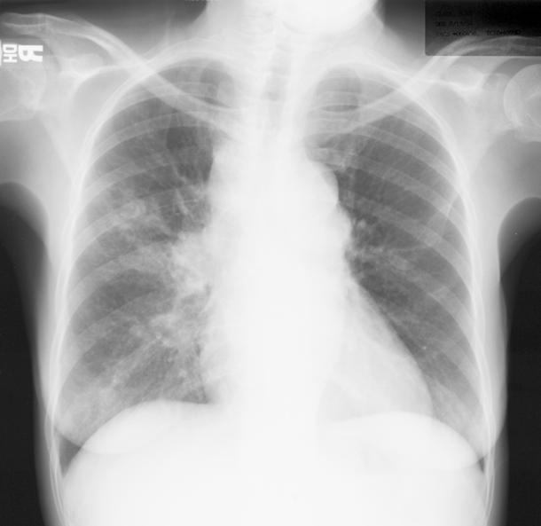 TB and AIDS: Radiographic Appearance The radiographic manifestations of HIV associated pulmonary TB are dependent on the level of immuno suppression.