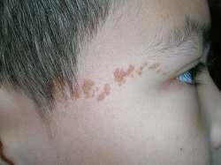 of a epidermal nevus syndrome