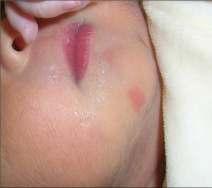 Erythema Toxicum Neonatorum Infantile Hemangioma