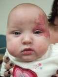 Infantile Hemangioma - Propranolol Vast majority do not require any medical or surgical intervention Propranolol for severe infantile hemangiomas (20mg/5mL) Off Label!