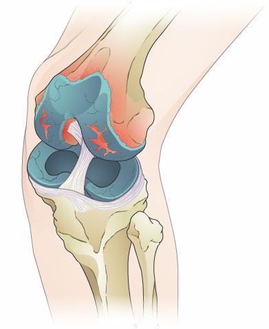 Knee Replacement Introduction Severe arthritis in the knee can lead to serious pain and loss of motion.