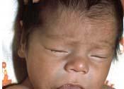 CONGENITAL HYPOTHYROIDISM (Cretinism) Clinical Manifestations: The majority of infants appear normal at birth, and <10% are diagnosed based on clinical features, which include