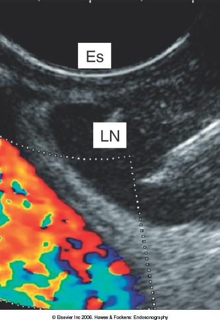 Endosonography High frequency miniature ultrasound transducer is incorporated into the tip of a conventional