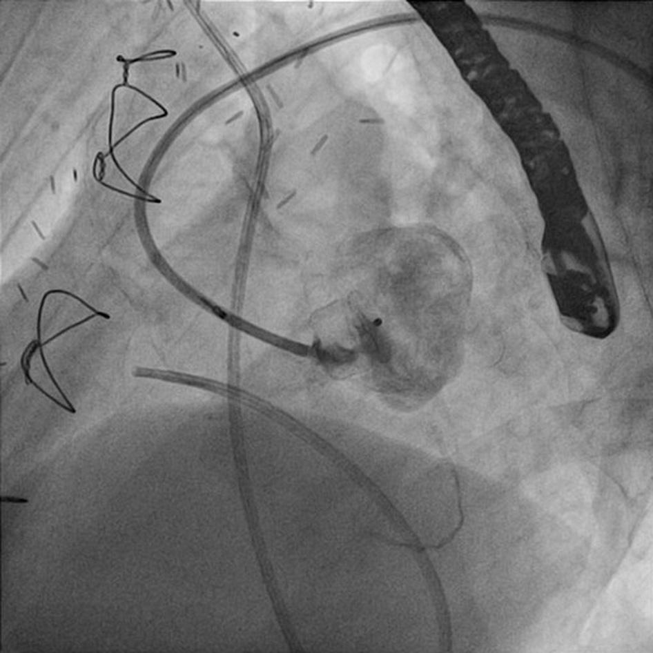In that situation transcatheter closure of the LVOT aneurysm can be done safely, especially with a AVP II.