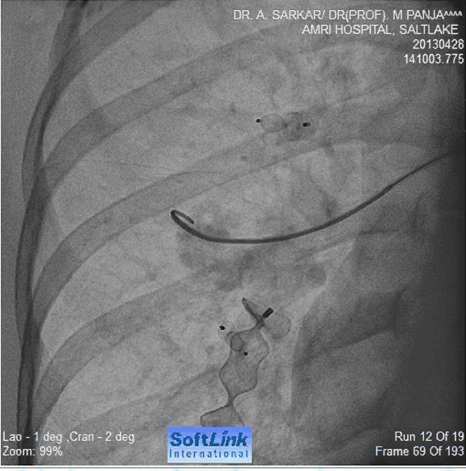 In view of strong suspicion of pulmonary arterio-venous (AV) fistula, CT pulmonary