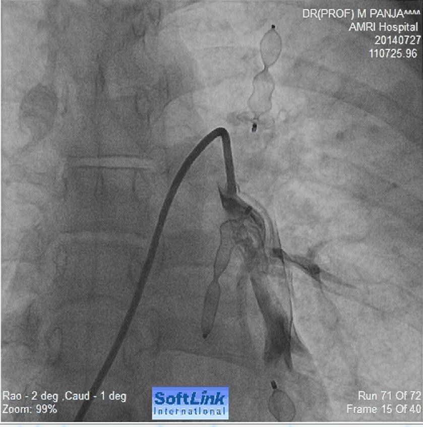 2012 Selectively cannulated by long Amplatz exchange wire through the 14F sheath 16 mm Amplazer type 2 vascular plug was deployed using 14 F delivery sheath.