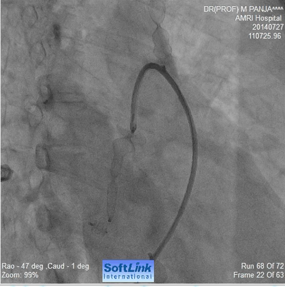 2014 Vascular Amplatz 16mm deployed in left lower lobe Vascular plaque closed the large left lower lobe fistula Another large fistula at the mid zone of the left lobe.