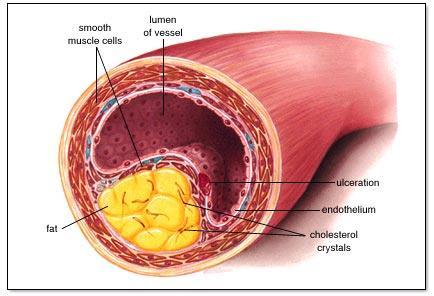 = fatty deposits in arteries - reduces blood flow if in brain =
